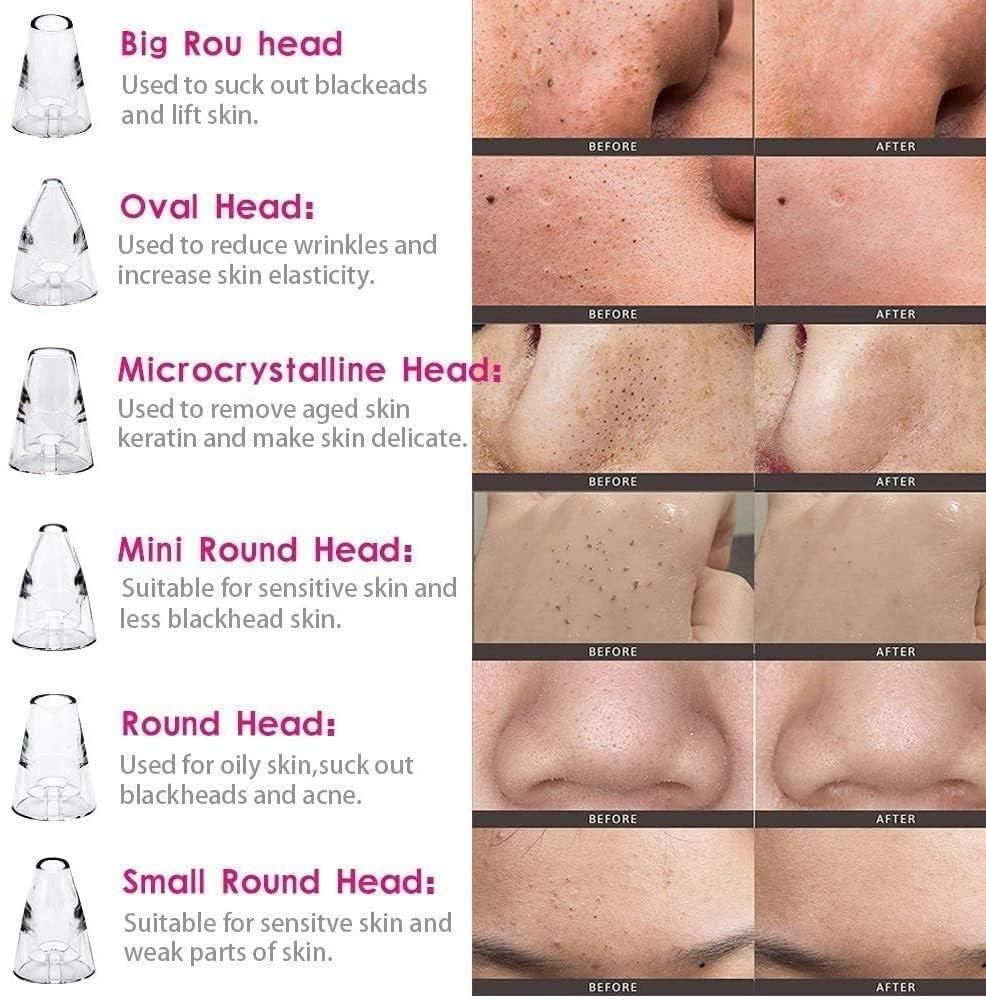 6 in 1 Multi-Function Blackhead Remover Tools